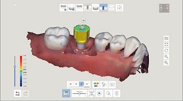 A.I. Abutment & A.I. Scan Body Matching