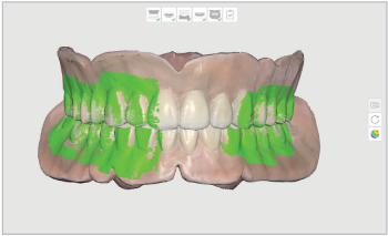 Denture Scanning